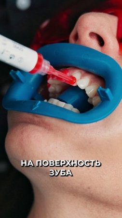 😳 Стоп-кариес: появилась нано-пленка, способная сохранить зубы