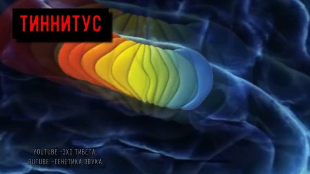 Что такое Тинитус (Шум в ушах)звон,свист