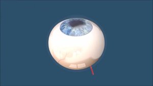 Коллагеновый кросслиникинг с рибофлавином - укрепление роговицы при кератоконусе