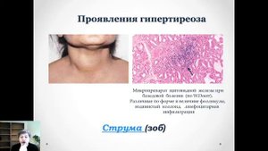 II 23. Патофизиология щитовидной и паращитовидной желез
