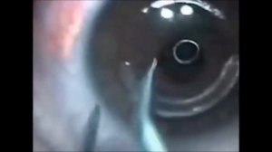 Установка роговичных сегментов (колец) с фемтосопровождением при кератоконусе