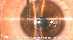 Фемтокросслинкинг при кератокоунсе - видео операции укрепления роговицы
