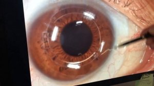 Склеральные линзы после кросслинкинга и установки интрастромальных роговичных сегментов