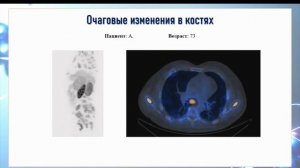 ОФЭКТ/КТ с 99mTc-PSMA у пациентов с раком предстательной железы