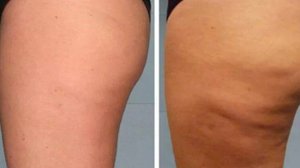 Причины целлюлита