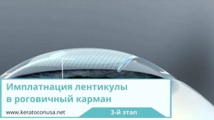Интрастромальная кератопластика лентикулой при кератоконусе - инфографика операции