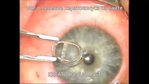 Myoring - видео операции установки роговичных колец при кератоконусе