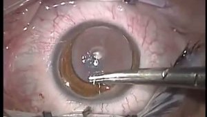 Сквозная кератопластика при кератоконусе (пересадка роговицы)