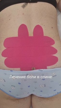 кинезиотейпирование. боль в спине. лечение. тейпирование. тейпы.