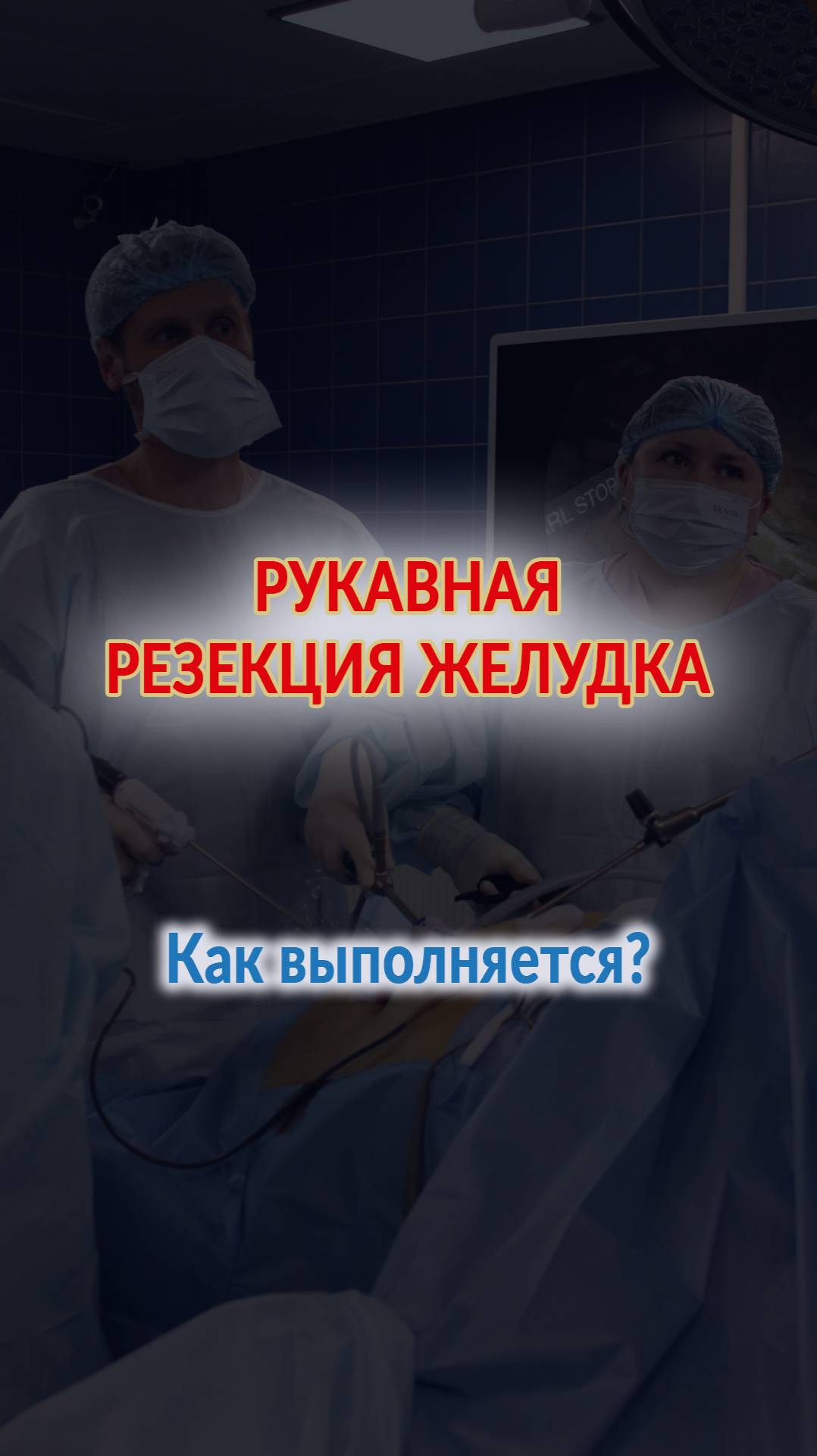 Рукавная резекция желудка. Как выполняется?