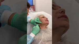 Коррекция ботулотоксином нижней трети лица.