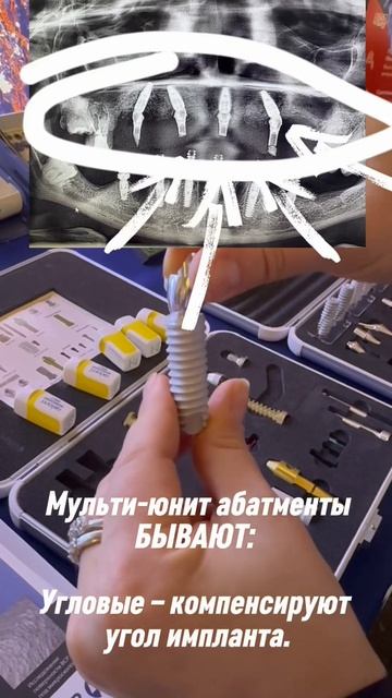 Протезирование на имплантатах — возможно всегда! #имплантация #имплантациязубов #зубы