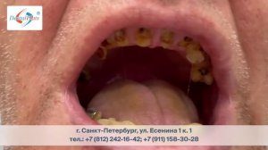 Протезирование на имплантатах