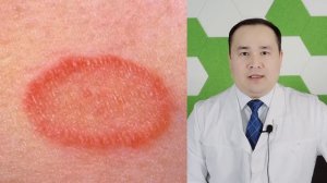 ТЕРИДА ТОШМАЛИ ЗАМБУРУҒ КАСАЛЛИГИ ВА УЙ ШАРОИТИДА ДАВ