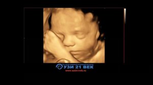 3д-4д УЗИ фото видео