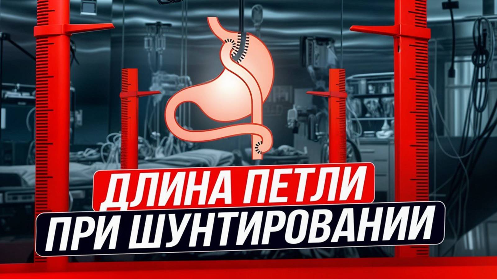 Длина петли при шунтировании