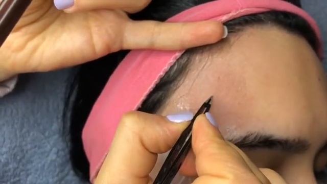 Электроэпилляция Ասեղային էպիլյացիա