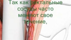 Дезартеризация геморроидальных узлов - лечение