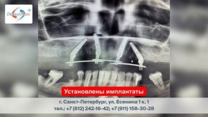 Протезирование на имплантатах. Зубы за 1 день!