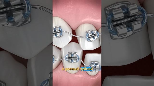 Зубы мудрости, когда нужно удалять?  #зубымудрости #удалениезубов #стоматология  #воспалениезуба