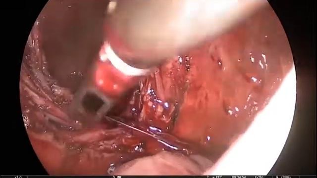 Vesicoscopic diverticulectomy Везикоскопическая дивертикулэктомия смотреть онлайн