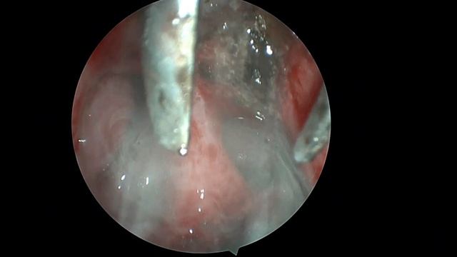 Папилломатоз носоглотки и аденоидные вегетации 2й сте смотреть онлайн