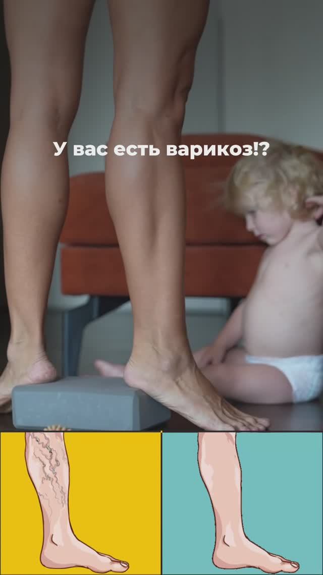 У вас есть варикоз? Подпишись и читай описание ✅