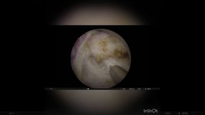 Опухоль в дивертикуле мочевого пузыря