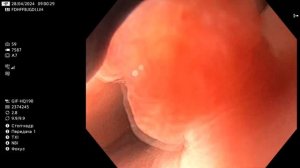 Полипы фундальных желез в желудке. Дисплазия? Гастрос?