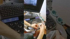 ФАНТОМНЫЕ БОЛИ культи, невринома и спайки. Как разраба