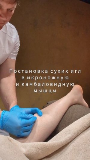 СУХИЕ ИГЛЫ 💉 АКУПУНКТУРА 💉 ИГЛОУКАЛЫВАНИЕ