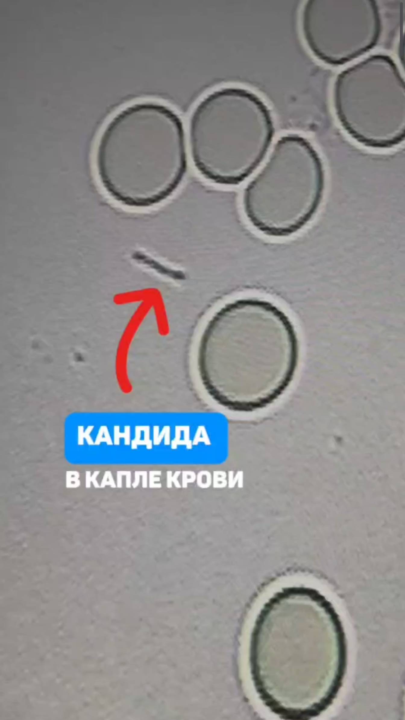 Кандида в крови. В чем опасность и как избавиться? Алена Братишко