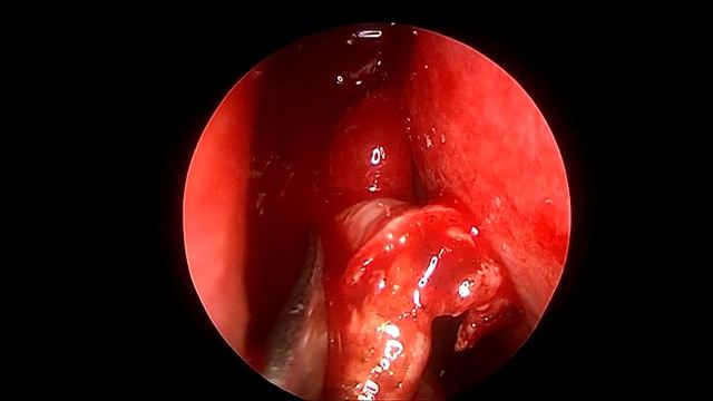 ЭНДОСКОПИЧЕСКАЯ ДАКРИОРИНОЦИСТОСТОМИЯ (+ отдаленный ? смотреть онлайн