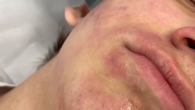 Ультразвуковая чистка лица