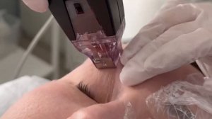 Микроигольчатый RF лифтинг InMode Morpheus 8