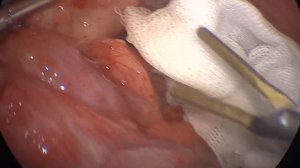 лапароскопическая аппендэктомия 1