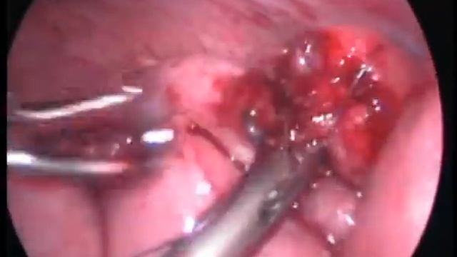 Лапароскопическое удаление инородного тела ЖКТ (магн? смотреть онлайн