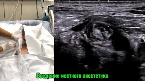 ПОДКЛЮЧИЧНАЯ БЛОКАДА ПЛЕЧЕВОГО СПЛЕТЕНИЯ #узи #anatomy #ult