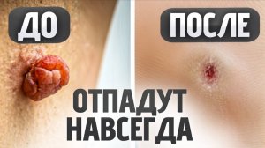Папилломы отпадут САМИ навсегда – просто сделай ЭТО дома!