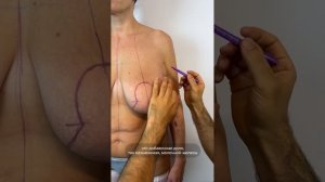 ВЫПОЛНЕНА РЕДУКЦИОННАЯ МАММОПЛАСТИКАФ. Доктор Карапетян