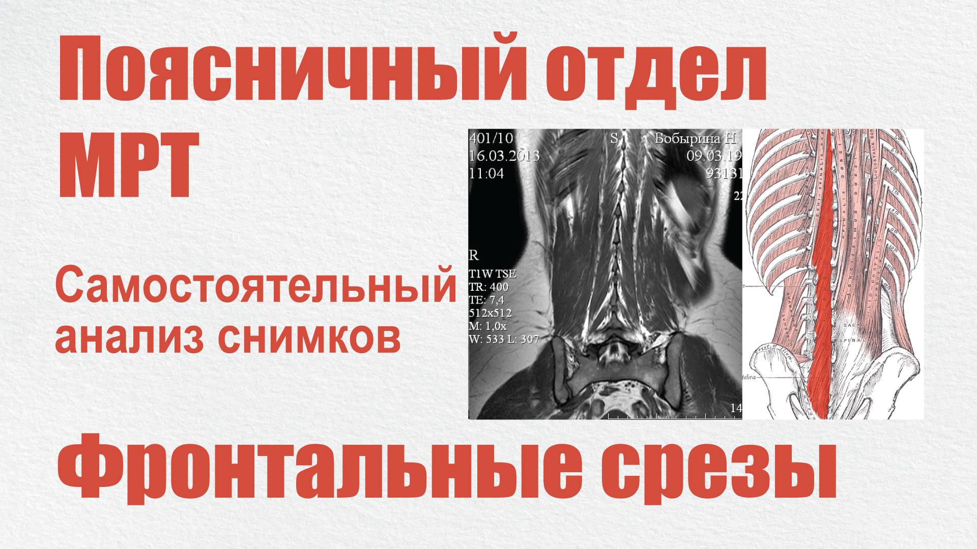 Миофиброз. МФС. Разбор МРТ