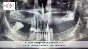 Протезирование на имплантатах. Зубы за 1 день!