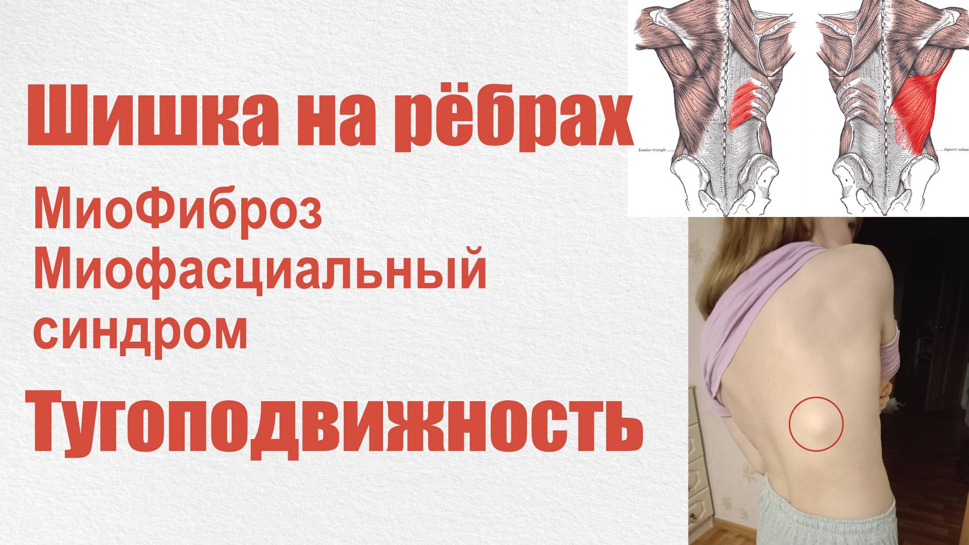 Тугоподвижность одной стороны тела. Шишка на рёбрах. МФС. Миофиброз. Лечение.
