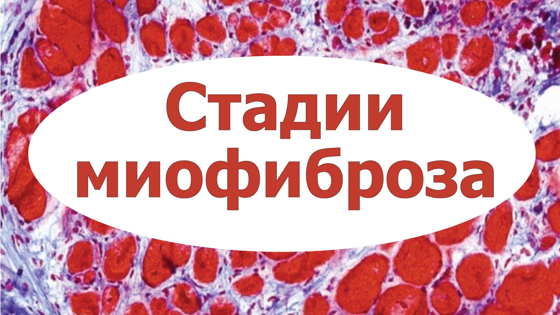 Стадии миофиброза. УЗИ мышц
