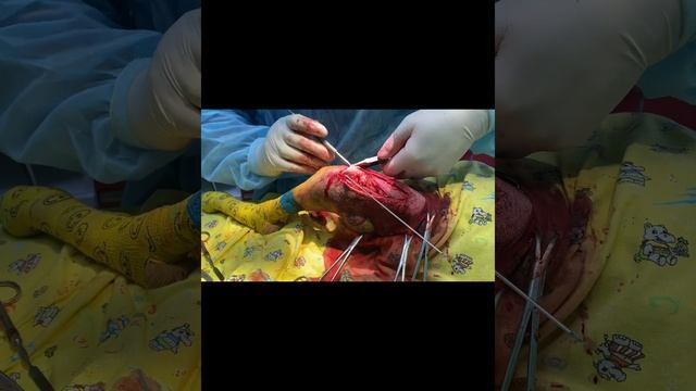 Дистальный перелом бедра у щенка