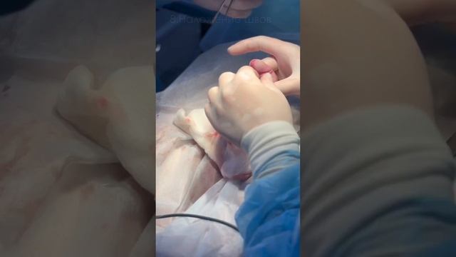 КАК делают ОБЫЧНОЕ ОБРЕЗАНИЕ? (ВИДЕО 18+) #обрезание #кли смотреть онлайн