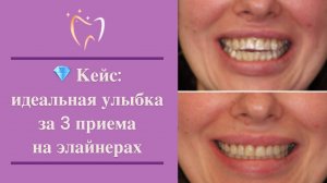 💎 Идеальная улыбка за 3 приёма на элайнерах — за 8 месяцев!
