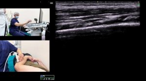 АРКАДА ФРОЗЕ: УЩЕМЛЕННИЕ ГЛУБОКОЙ ВЕТВИ ЛУЧЕВОГО НЕРВА #узи #ultrasound #нервы #anatomy #anaesthesi