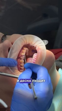 Почему десна может оголять корни зубов? ❤️ Стоматология “СТОЛИЦА”  Москва, ЦАО. Круглосуточно!