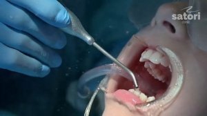 Профессиональная чистка зубов перед фиксацией брекетов #orthodontist #bracket #брекеты